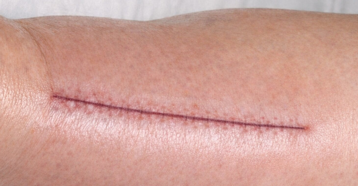 Movant Academy: Oedeem & littekens - het vergeten vervolg van chirurgie